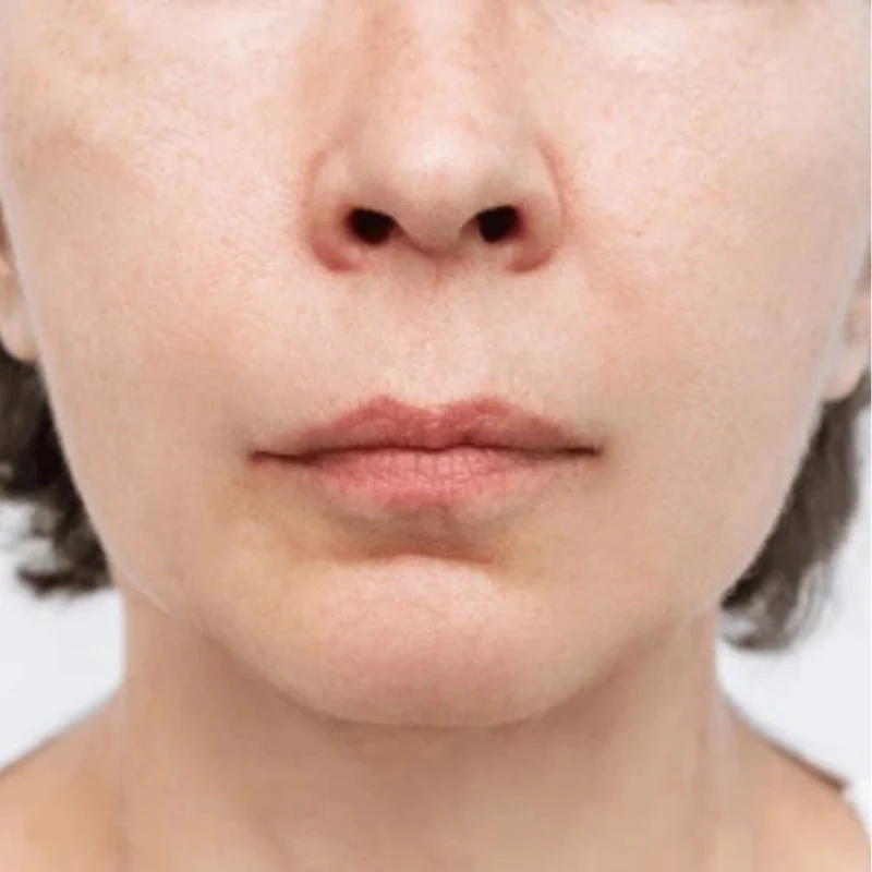 Yüz Şekilendirici Çene Maskesi